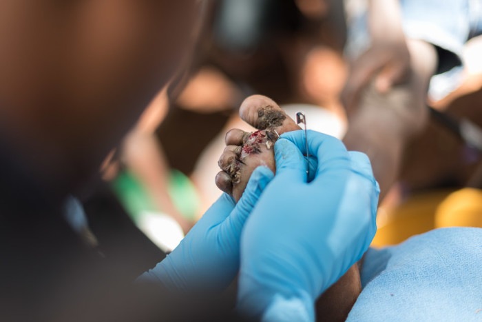 20150317_uganda-jigger-clinic_0248